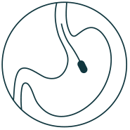 Swallowable Gastric Balloon